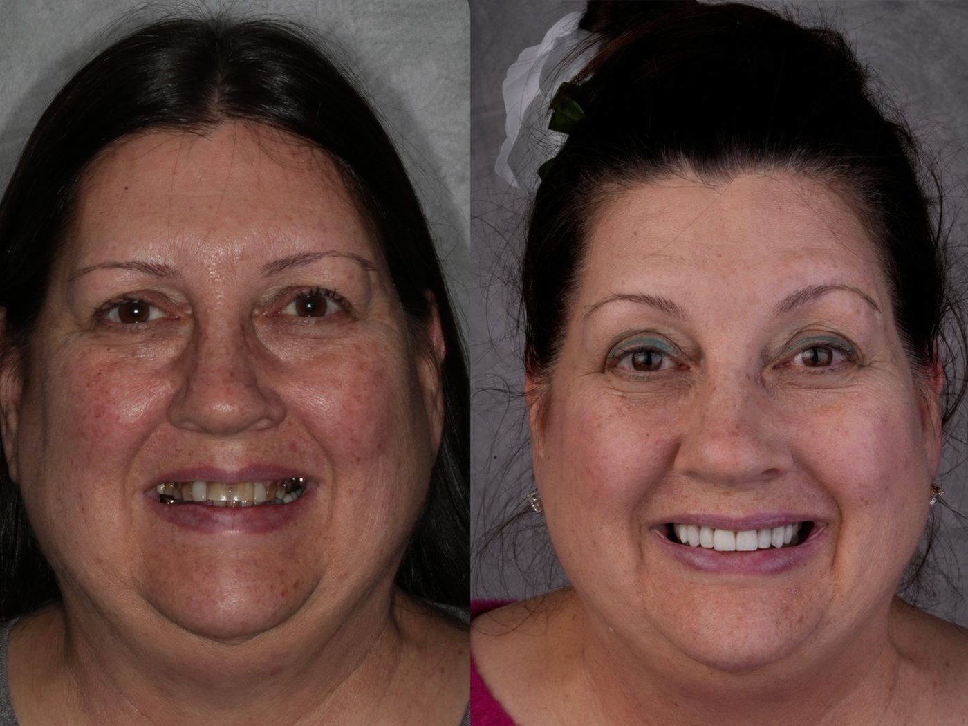 Full smile reconstruction