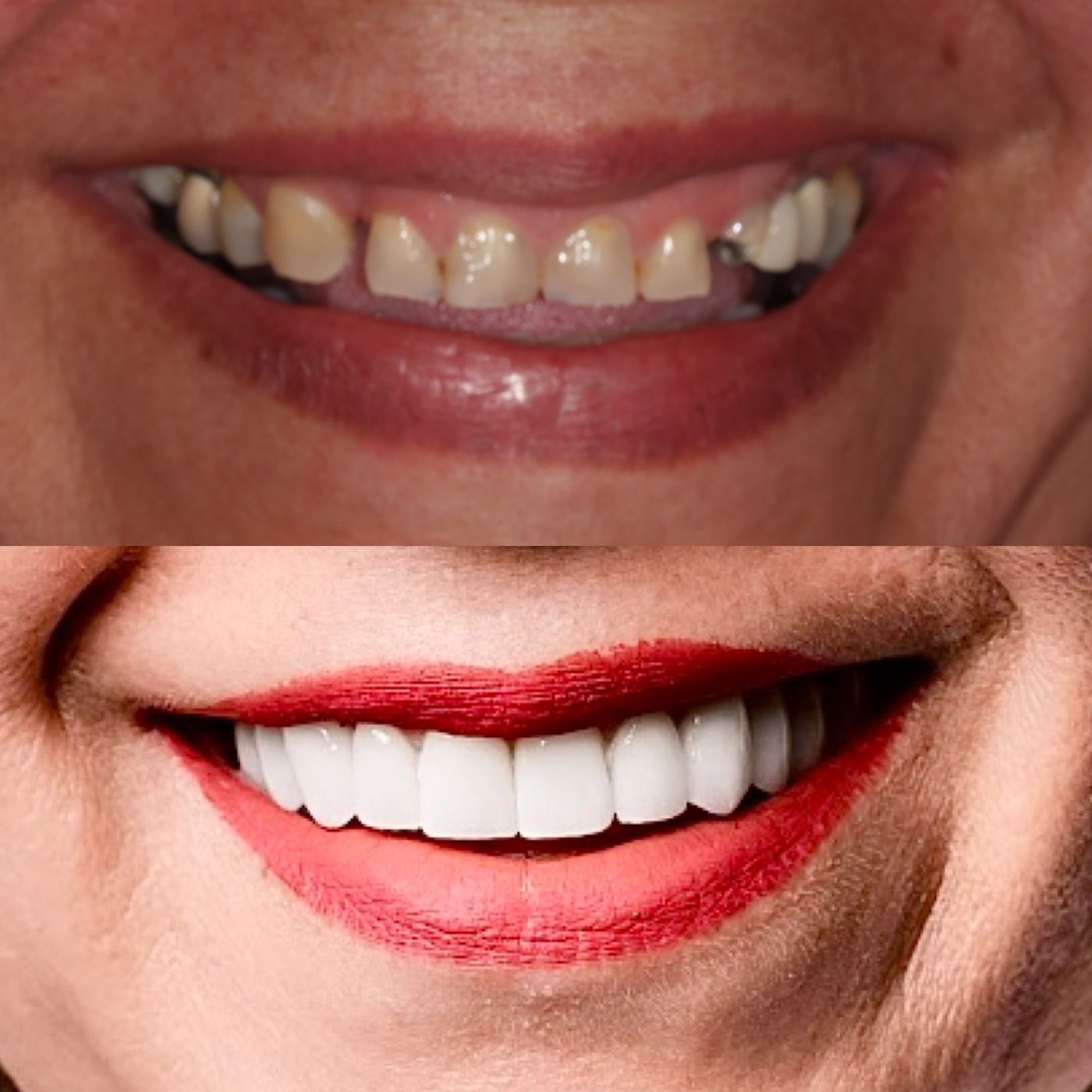 Crowns, bridges & gum lift