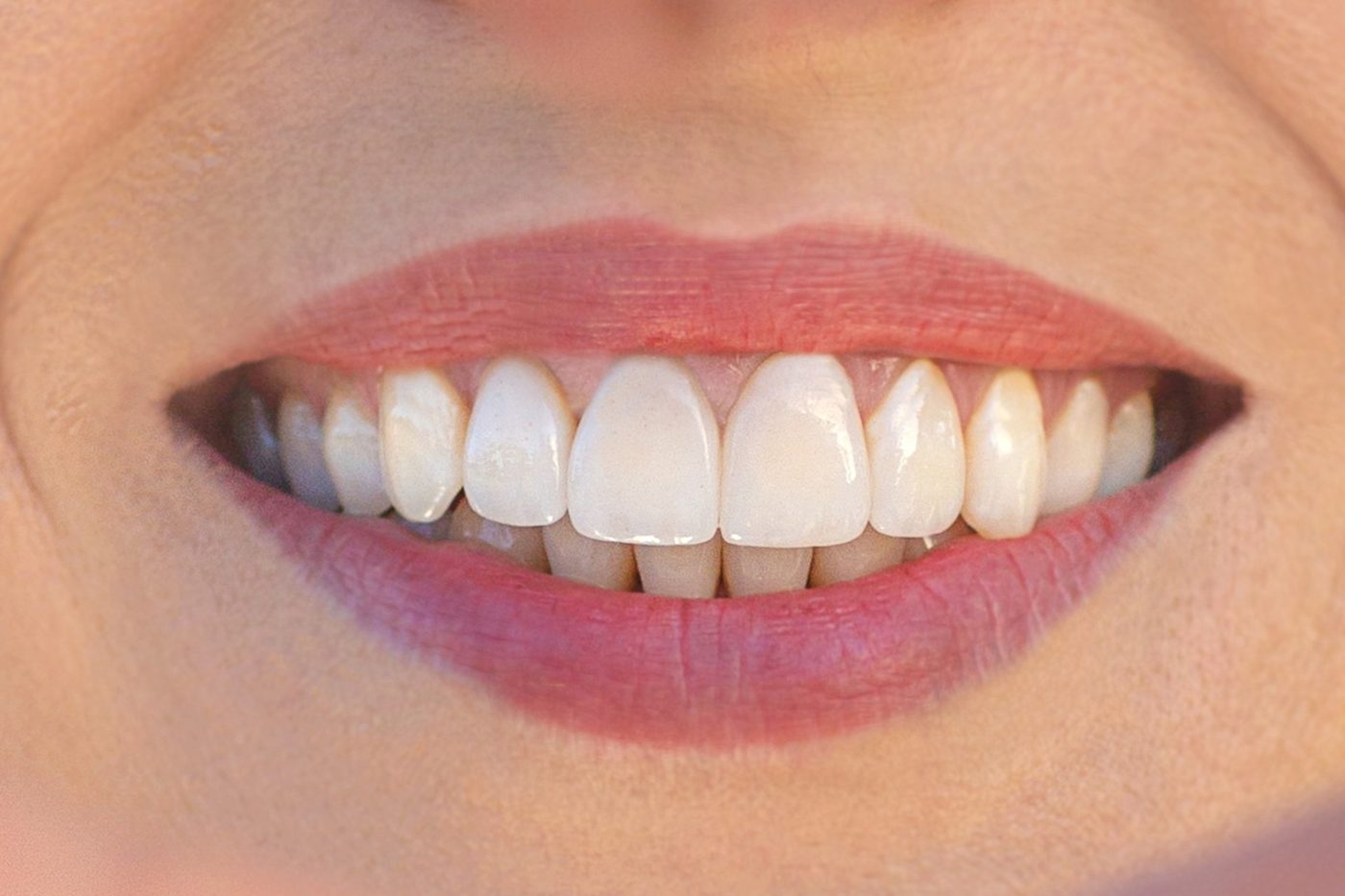 Patient with restored, natural-looking crown