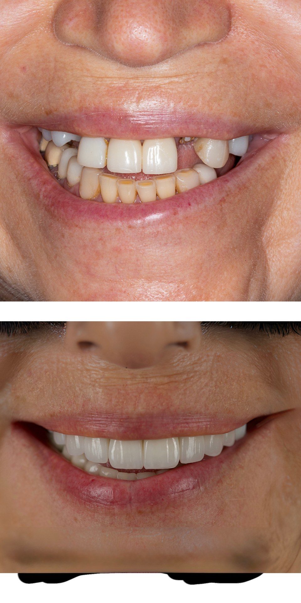 Full-mouth rehabilitation with smile design