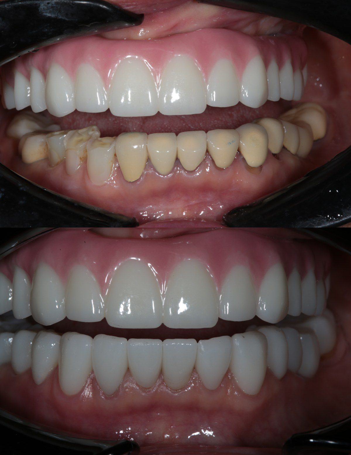 Lower arch restoration with bite correction in Tustin, CA — before and after by Dr. Marta Rudat