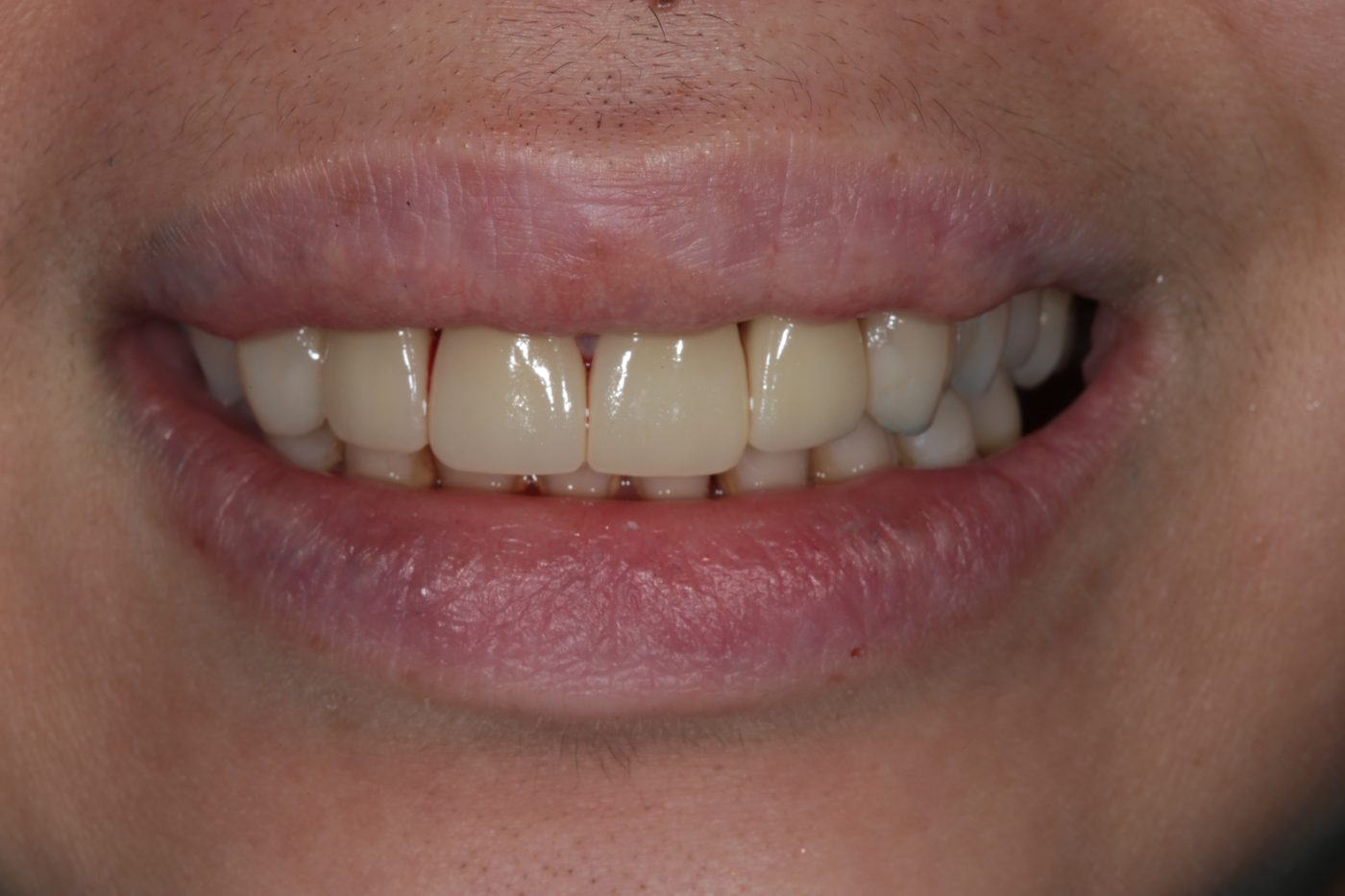 Natural, restored smile close-up