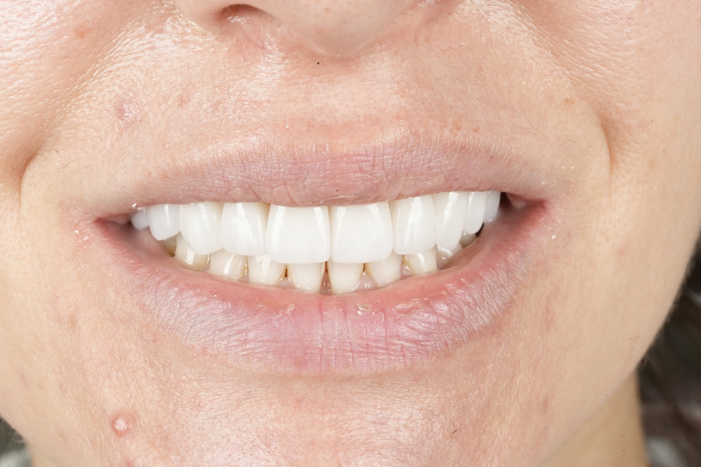 Close-up of a restored natural smile