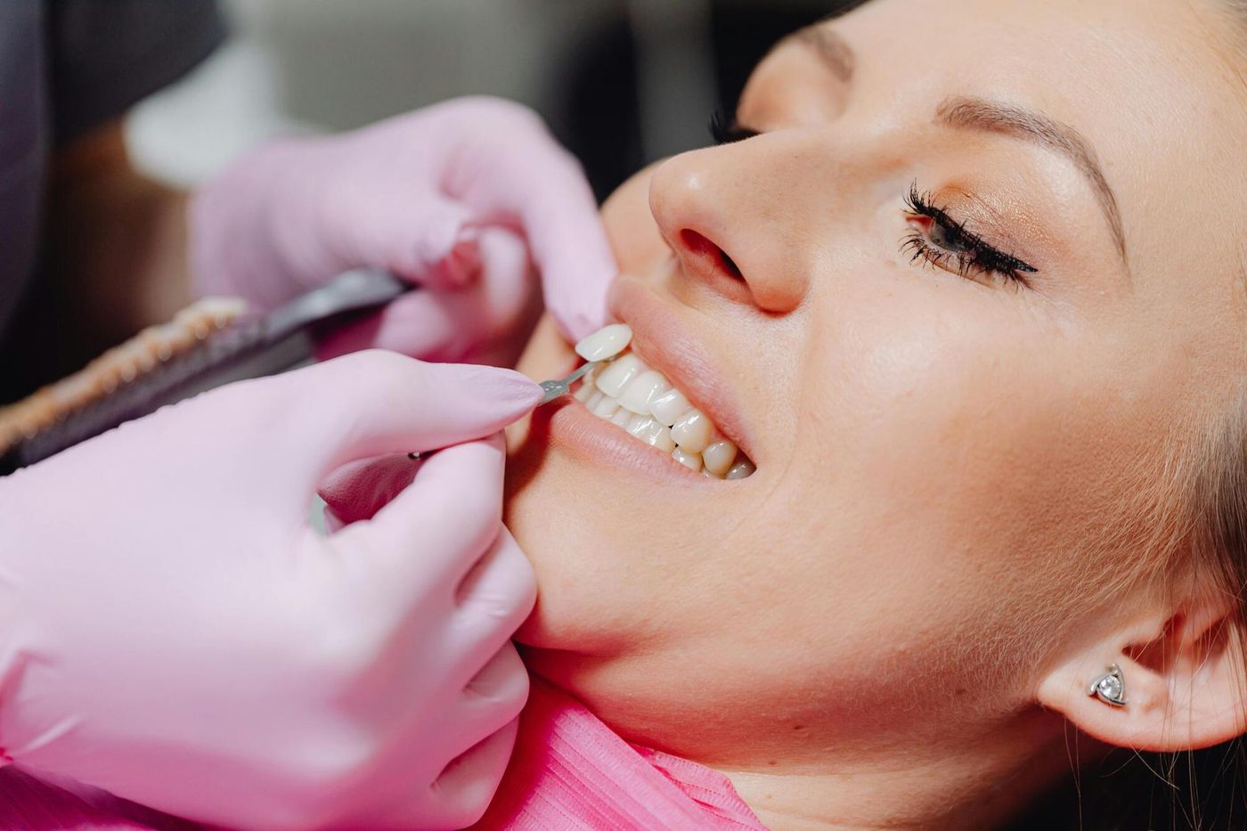 What Happens to Teeth Under Veneers?