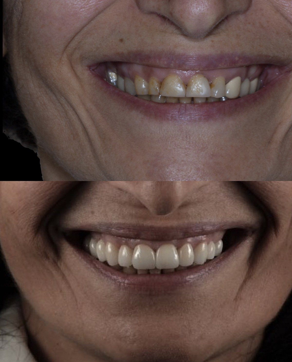 Gum lift, crowns & bridges with smile design in Tustin, CA — before and after by Dr. Marta Rudat
