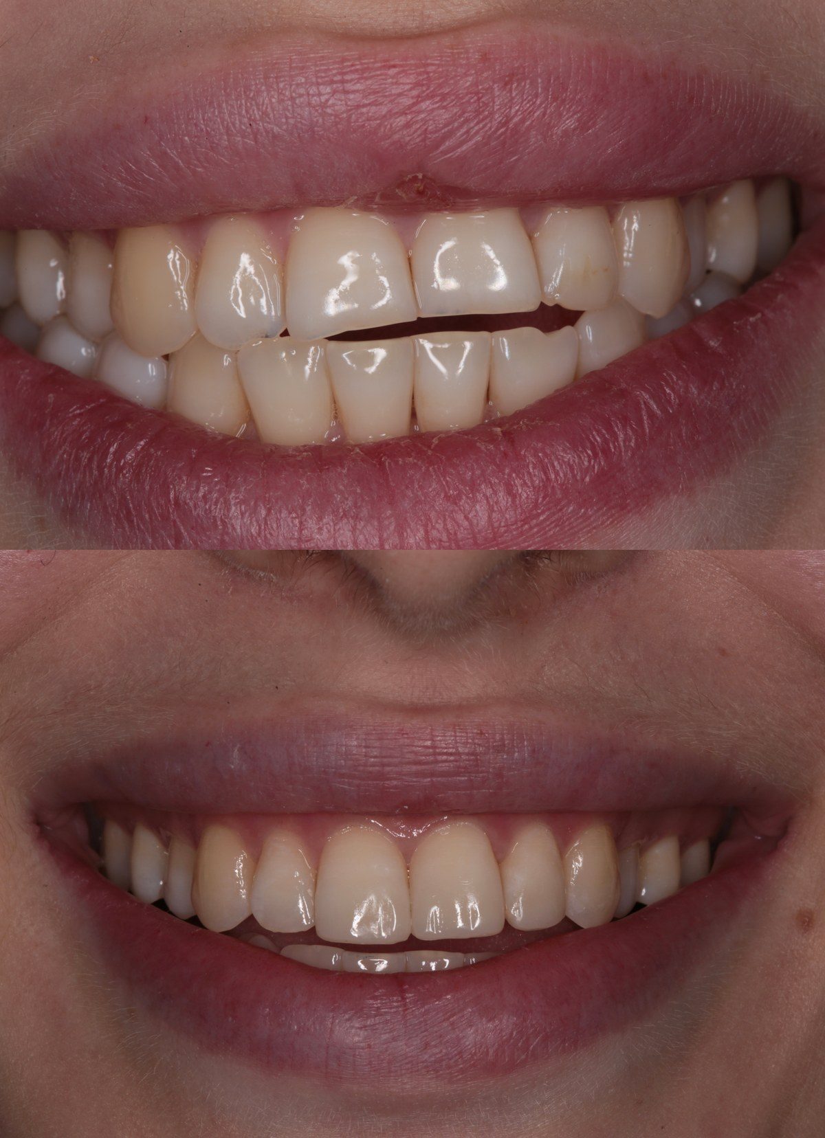 Composite veneers & lingual bonding in Tustin, CA — before and after by Dr. Marta Rudat