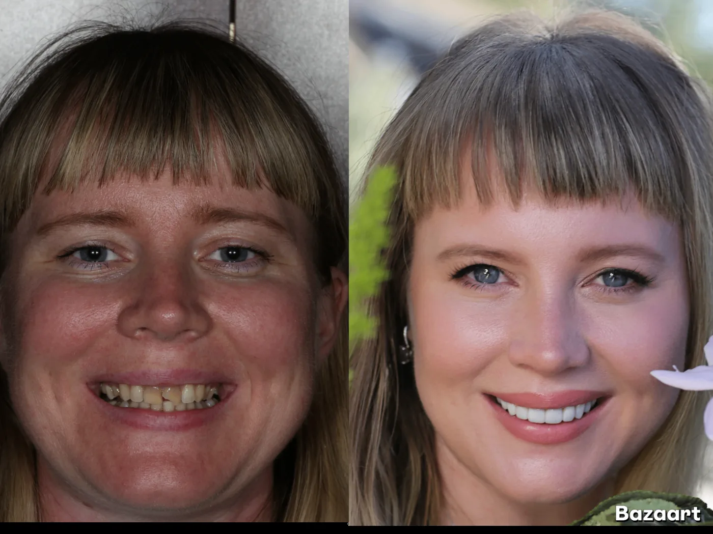 Full-mouth restoration