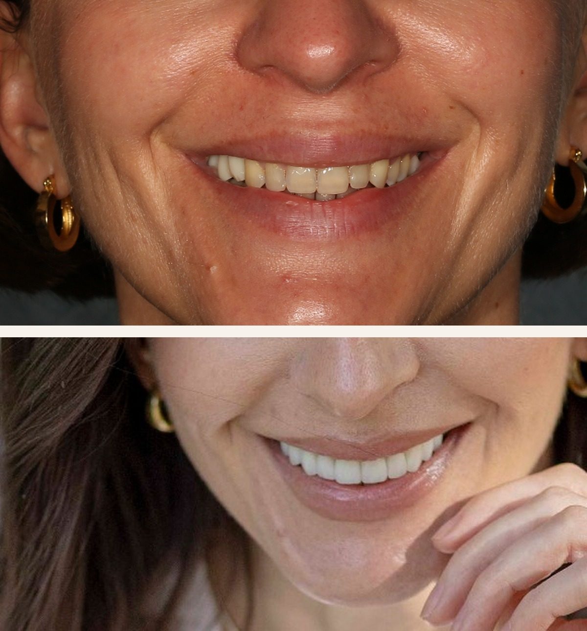 Smile design, veneers & implant bridge in Tustin, CA — before and after by Dr. Marta Rudat