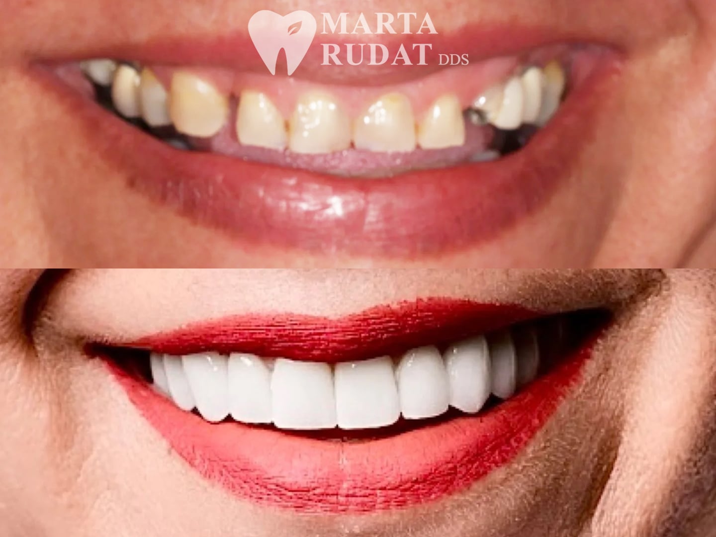 Before and after dental crowns showing restored front teeth
