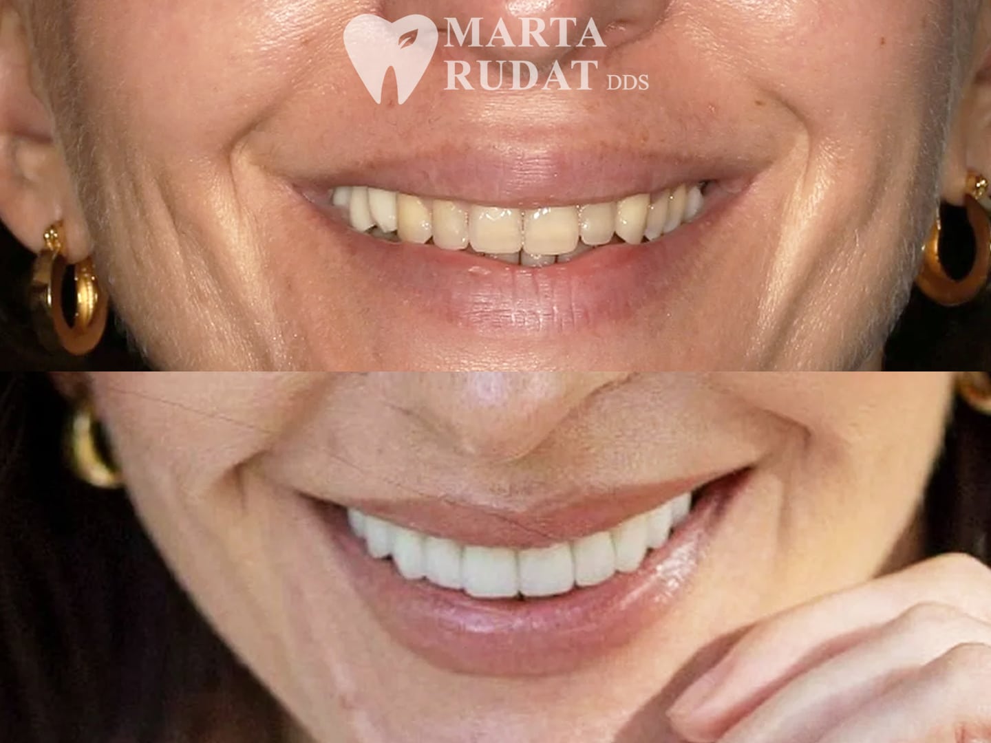 Before and after dental implant treatment showing a restored smile