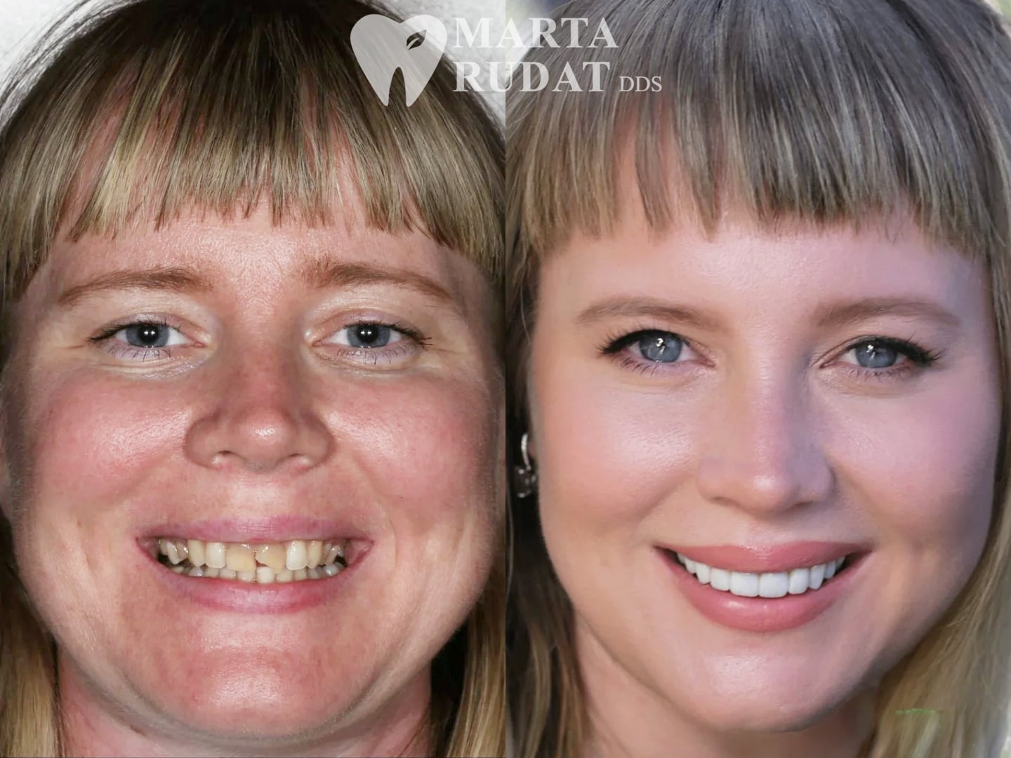 Before and after full mouth restoration with veneers and overlays to restore a broken tooth, uneven tooth color, and areas treated with a gum lift.