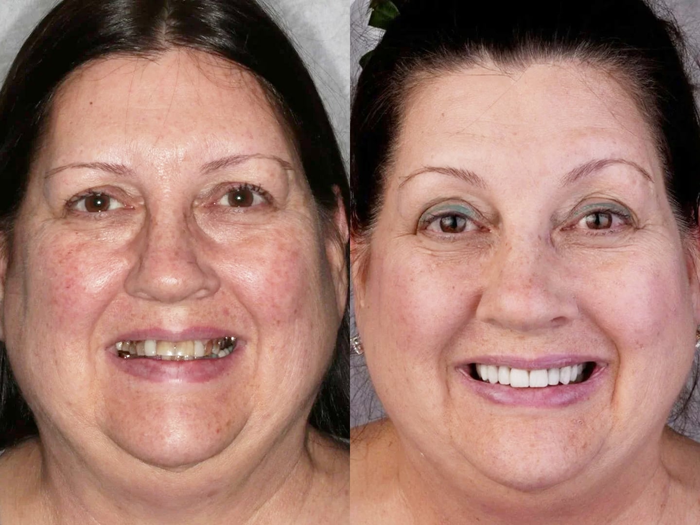 Before and after full smile reconstruction with four crowns on the back teeth and composite veneers on the eight front teeth.