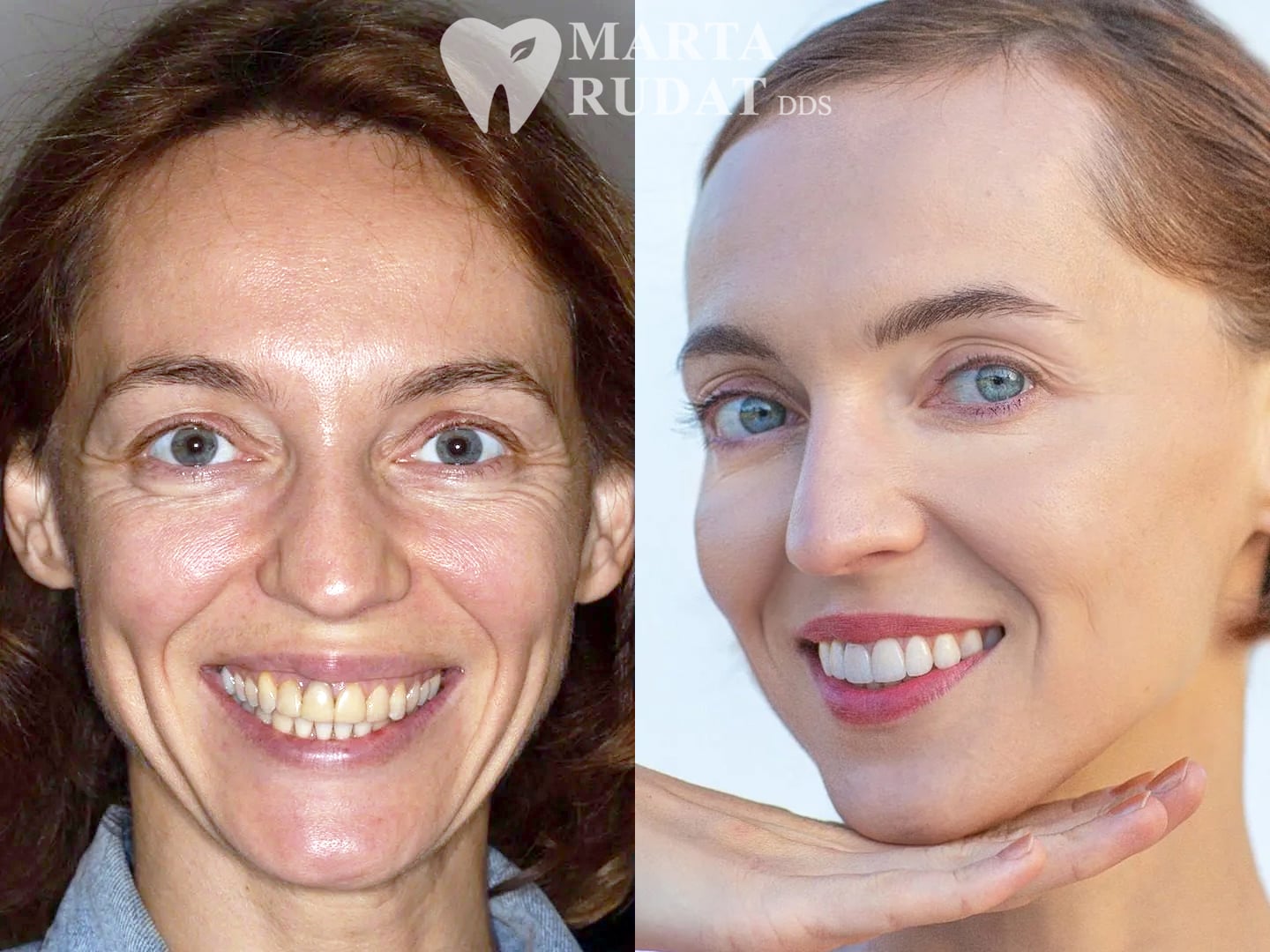 Before and after porcelain veneers and crowns on the upper arch with teeth whitening to improve stained and misshapen front teeth.