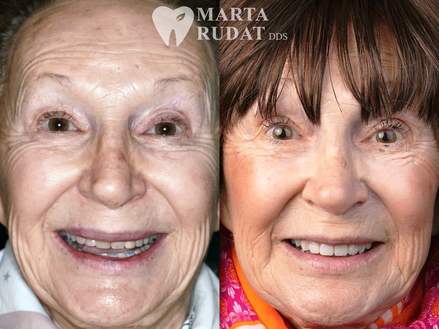 Before and after full smile makeover with a crown, three veneers, and composite bonding to correct chipped teeth, uneven tooth color, and old restorations.