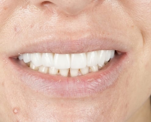 Close-up of a woman smiling while wearing whitening strips on her upper teeth