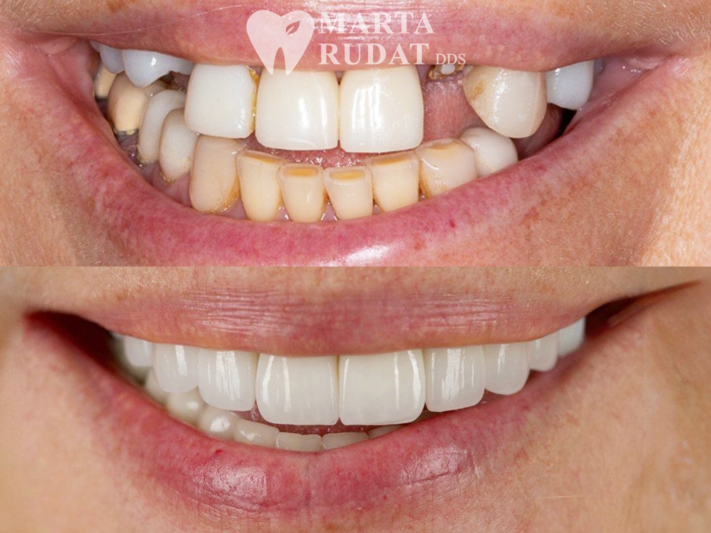 Before and after full-mouth reconstruction with crowns, veneers and implants