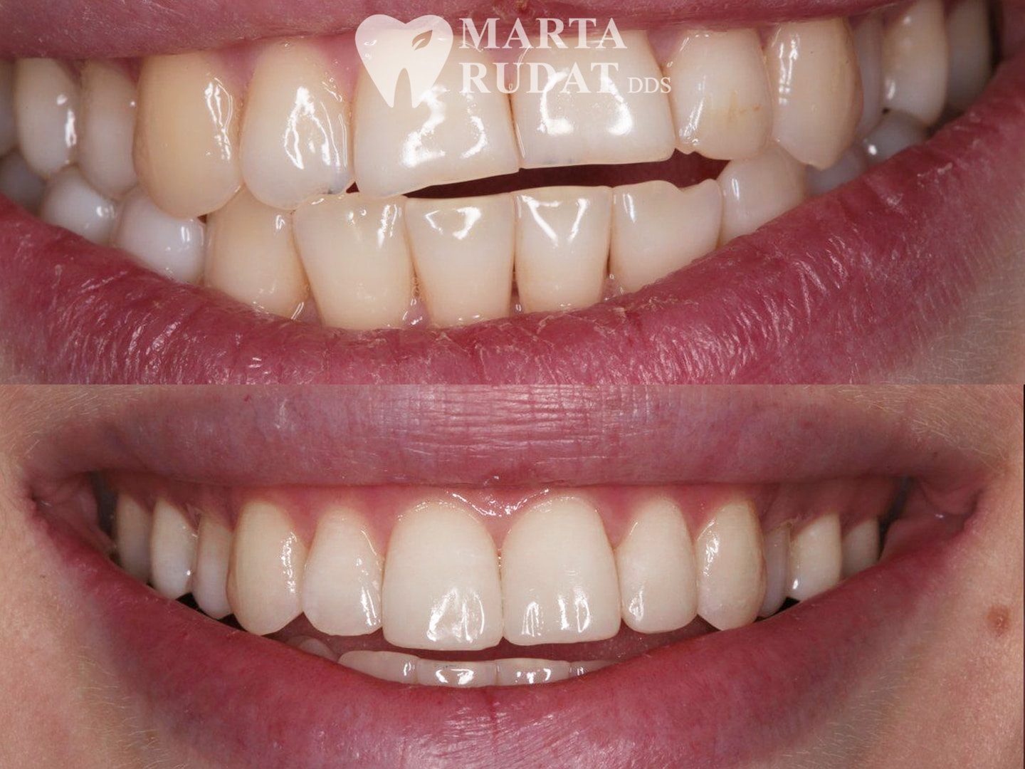 Before and after composite veneers and lingual bonding