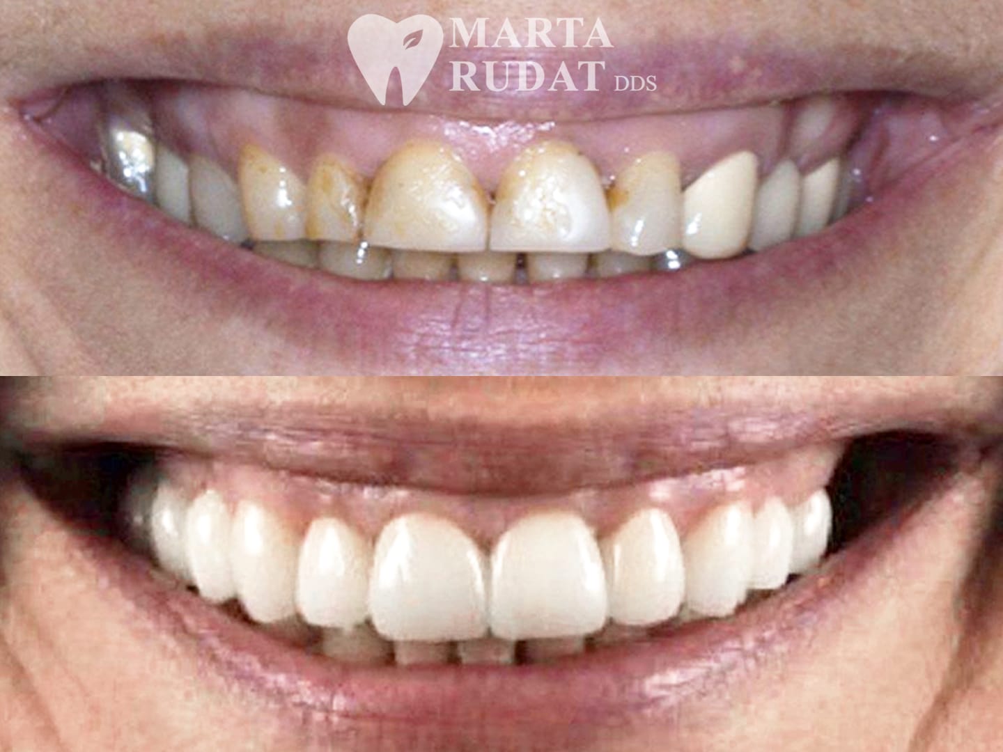 Before and after gum lift, crowns and bridges