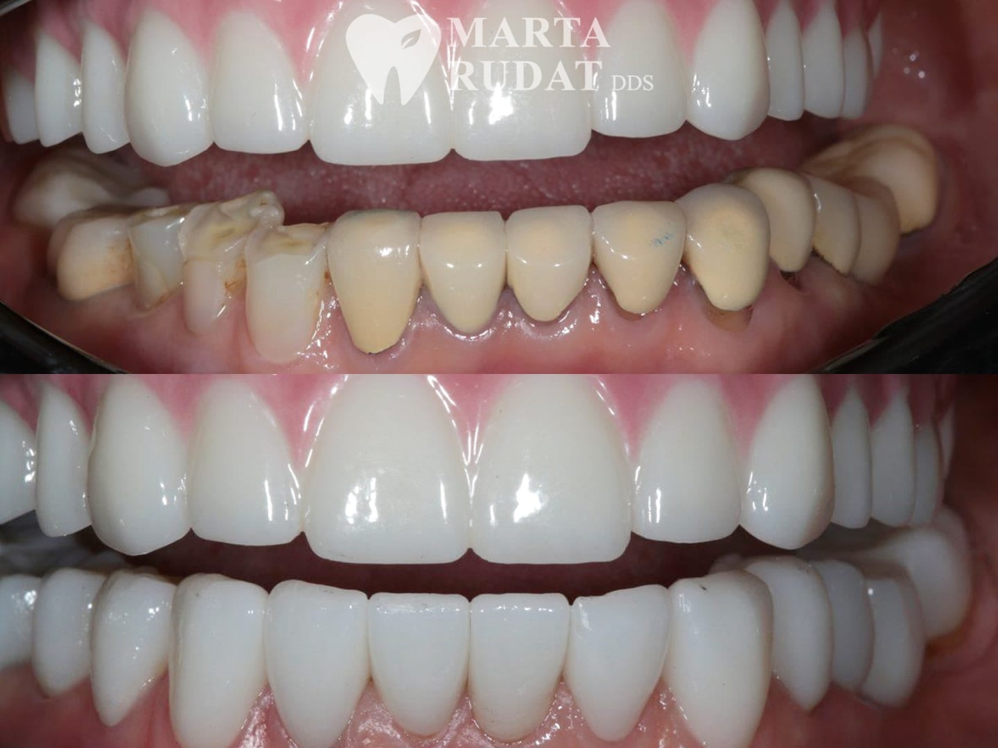 Before and after lower arch restoration with crowns and bridge