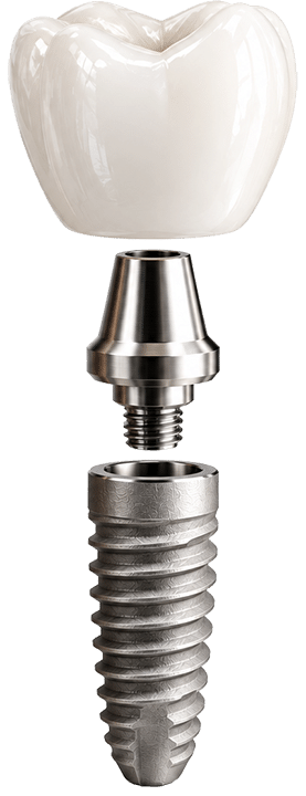 Three parts of a dental implant showing the crown, abutment, and titanium implant post