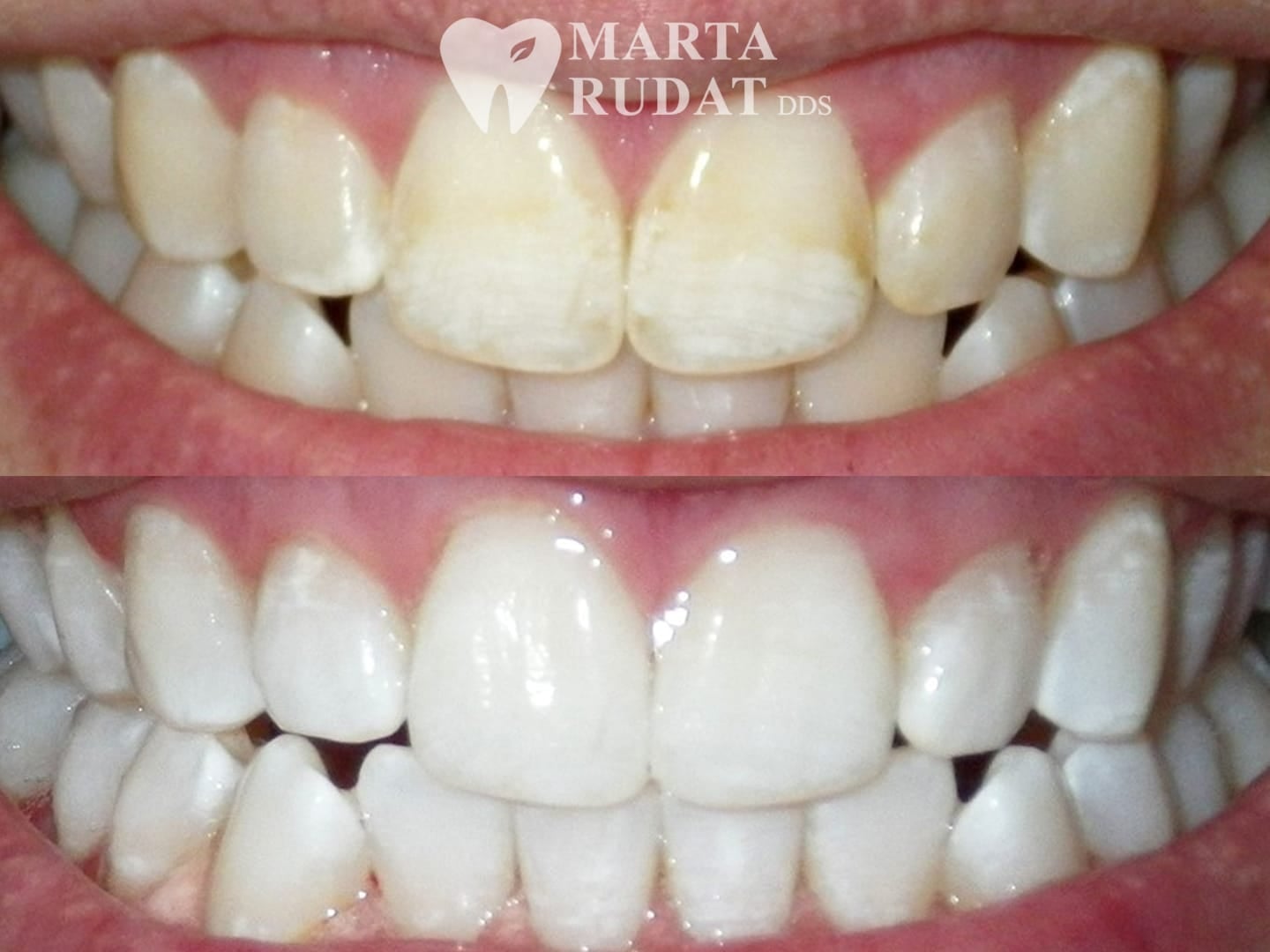 Before and after teeth whitening showing improvement in yellow tooth discoloration