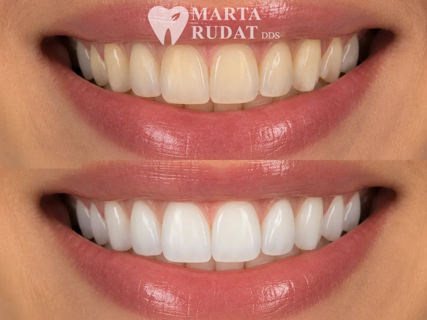 Before and after professional teeth whitening showing a brighter, whiter smile