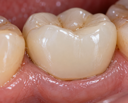 Close-up of a dental crown on a back tooth