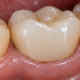 Close-up of a dental crown on a back tooth
