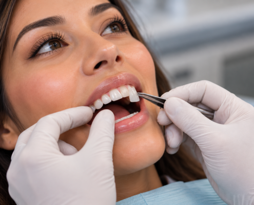 Porcelain veneer being placed on a patient's front tooth