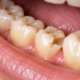 Broken back tooth with a fractured cusp